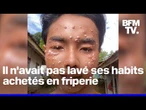 Ce tiktokteur contracte le molluscum contagiosum, responsable de pustules sur son visage