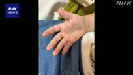 手足口病 15都県で警報レベル 手洗いの徹底を