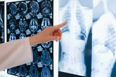 Tumore ai polmoni, nuovo farmaco "blocca" la malattia