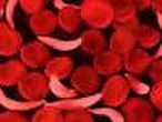Nigeria Has Highest Prevalent Rate of Sickle Cell Worldwide, Says FG