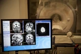 Sufrir trastornos digestivos incrementa el riesgo de padecer Alzhéimer y Párkinson: "Salud intestinal es salud cerebral"