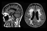 Un 'empujón' de la ciencia para maximizar la recuperación del cerebro tras un ictus