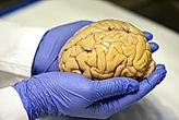 La nueva generación de fármacos y diganóstico abre una nueva era frente al alzhéimer: "No debemos olvidar la necesidades que no cambian"
