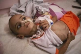 La agonía de Amr, el niño con una lesión cerebral que lucha por su vida en el devastado sistema sanitario de Gaza