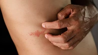 La vacuna frente al herpes zóster también es un escudo contra las enfermedades cardiovasculares