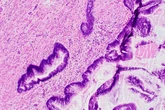 Un estudio en EEUU plantea que los nacidos en los 80 pueden desarrollar hasta cuatro veces más casos de cáncer de apéndice que los nacidos en los 40