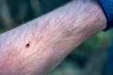 Síndrome Alfa-Gal: ¿Qué es y por qué se está extendiendo la alergia a la carne roja causada por la picadura de garrapata?