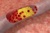 ¿El malo o el bueno? "El colesterol útil no debe ser confundido con el colesterol que medimos cuando hacemos un análisis de sangre"
