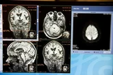 El Plan Español del Cerebro afrontará los trastornos cerebrales que sufrirá uno de cada dos españoles