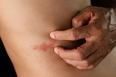 Descubren un nuevo antiviral contra el herpes simple que vence la resistencia a los tratamientos actuales