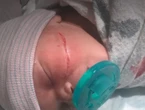 Newborn’s face slashed in C-section
