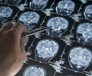 Pacjenci słyszą i widzą zmarłych. Tajemnicza choroba atakuje mózg. Lekarze bezradni