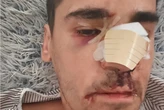 El periodista Fonsi Loaiza denuncia una "brutal agresión": "Lo último que recuerdo es que me llamaron 'rojo, subcampeón' antes de quedar inconsciente"