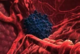 Cáncer de hígado: una nueva estrategia terapéutica mejora la supervivencia de los pacientes inicialmente inoperables