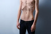 Ortorexia, permarexia o alcohorexia: los trastornos de la conducta alimentaria no específicos ya casi doblan a la bulimia y la anorexia nerviosa tradicionales