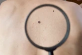 Una vacuna de ARNm reduce casi un 50% el riesgo de recaída en melanoma