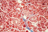 Así es el revolucionario fármaco para cáncer de páncreas que ya empieza a beneficiar al enfermo