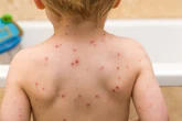 Why is NHS offering the chickenpox vaccine and is my child eligible?