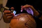 Two dead in India after hair transplant surgery goes horribly wrong