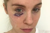 ‘A spot under my eye turned out to be skin cancer aged just 26’