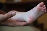 Doctors see surge in hand, foot and mouth cases this summer