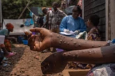 How Mpox revealed an epidemic of untreated HIV in Sierra Leone