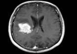 Common blood pressure drug could cure rare brain tumour