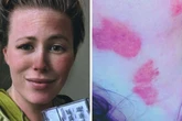 Mom ‘engulfed in flames,’ burns 48% of her body in smoker accident