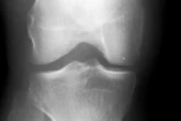 This walking style change can delay knee surgery for years