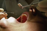 Scientists warn common dental condition could increase risk of stroke