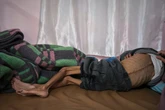 Children so malnourished they’re losing their sight: Inside Gaza