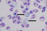 A woman got a fatal brain-eating ameba after rinsing her sinuses.