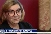 Cancer patient travels 300 miles to have 15 pound tumor removed