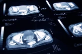 What are the symptoms of prostate cancer and how common is it?