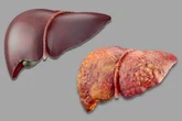 The common vegetables that can slow or reverse dangerous liver disease
