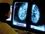 10,000 fewer patients began breast cancer treatment over past year
