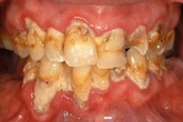 This natural compound could lead to new plaque-destroying toothpastes