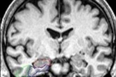 Compound found in hot drink could protect brain against Alzheimer’s
