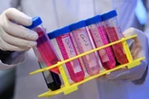 Long Covid causes effects similar to Parkinson’s or stroke