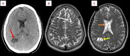 US man gets parasite in brain likely from eating undercooked bacon