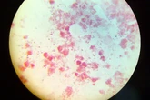 Gonorrhea and syphilis cases hit record highs in Europe