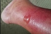 Health warning as ‘flesh-eating’ infections rise among beachgoers