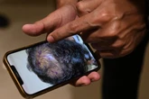 Man wins £5,000 after hair transplant shows ‘not even 1%’ result