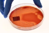 Aid cuts could lead to millions more dying from superbug infections