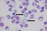 Nine-year-old dies from rare infection caused by ‘brain-eating amoeba’