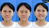 14 tiếng phẫu thuật, 3 tháng đeo "vương miện sắt", Xuân Mai hoá ngọc nữ xinh đẹp