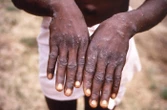 Ondo records 12 cases of Mpox