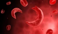 Eradicating sickle cell disorder with “1k4Sickle”