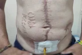 Тіло вкрите каліцтвами. Звільнений з полону боєць показав жахливі сліди катувань
