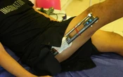 Allongement des jambes en Turquie : notre reporter raconte cette tendance risquée
